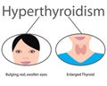 Hyperthyroidism. Enlarged Thyroid. Endocrine disfunction vector illustration Royalty Free Stock Photo