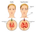 Hyperthyroidism