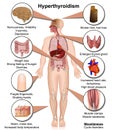 Hyperthyroidism medical vector illustration isolated on white background infographic
