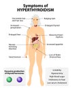 Hyperthyroidism or over active thyroid. hyperthyreosis Royalty Free Stock Photo