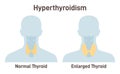 Hyperthyroidism. Thyroid gland produces too much of the hormone