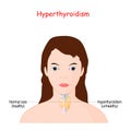 Hyperthyroidism. Woman with thyroid gland