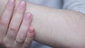 Hypertrichosis of the hands close-up. Excessive hair growth Hand depilation