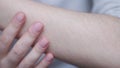 Hypertrichosis of the hands close-up. Excessive hair growth Hand depilation