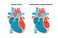 Hypertrophic cardiomyopathy with cross-section view. Human heart muscle diseases. Cardiology concept. Royalty Free Stock Photo