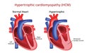 Hypertrophic cardiomyopathy, Heart disease, Vector image