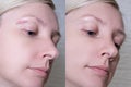 Hypertrophic keloid scar on woman face before and after laser treatment, removal, heal and recovery after accident or damage, Royalty Free Stock Photo