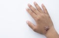 Hypertrophic scar Keloid scar on hand back of young Asian woman on white background Royalty Free Stock Photo