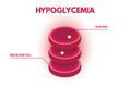 Hypoglycemia, Human glucose levels isometric.