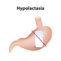 Hypolactasia. Lactose intolerance. Stomach. A glass of milk. Infographics. Vector illustration on isolated background