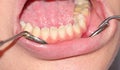 Hypoplasia of tooth enamel