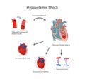 Hypovolemic shock pathology. Compensatory mechanisms of hypovolemic shock Royalty Free Stock Photo