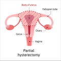 Hysterectomy, surgical removal of the uterus. Medical vector illustration shows one type of hysterectomy partial, when