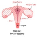 Hysterectomy, surgical removal of the uterus. Medical vector illustration shows one type of hysterectomy radical, when