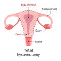 Hysterectomy, surgical removal of the uterus. Medical vector illustration shows one type of hysterectomy total, when