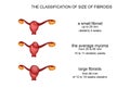 Hysteromyoma, uterine myoma
