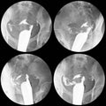 Hysterosalphingography The uterus is normal size and shape