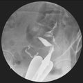 Hysterosalpingography HSG is a fluoroscopic study of a woman`s uterus and fallopian tubes