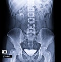 I.V.P is an X-ray exam of urinary tract after injection contrast media agent 20 minute