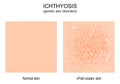 Ichthyosis. genetic skin disorders. Normal and skin of a person with ichthyosis Royalty Free Stock Photo