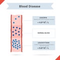 Icon blood disease leucocytosis and leukopenia Royalty Free Stock Photo