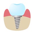 Icon of the implant installed in the bone in the section.