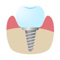 Icon of the implant installed in the bone in the section. Royalty Free Stock Photo