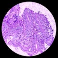 Ileo-cecal ulcer (biopsy): Chronic nonspecific ileitis. IBD.