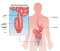 Ileoanal anastomosis 