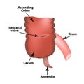 Ileocecal angle. Ileocecal valve. Bauginiev s damper. The ileum, the Cecum, the Apendix. Colon. Infographics. Vector illustration