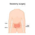 Ileostomy. stoma. surgical opening of small intestine