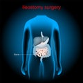 Ileostomy. stoma. surgical opening of small intestine