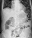 Ileus