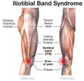 Iliotibial band syndrome, painful knee joint. Labeled Illustration