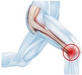 Iliotibial band syndrome, painful knee joint, inflammation or overuse. Illustration