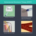 Extracorporeal Shockwave Therapy. ESWT Royalty Free Stock Photo