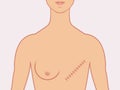 Illustrated mastectomy