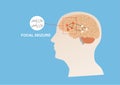 Illustration of abnormal electrical activity causing focal seizure