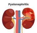 Illustration of the accute pyelonephritis with the pus inside the kidney and severe inflammation