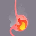 Illustration from acid reflux or heartburn.