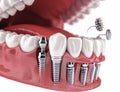 An illustration of the All on 6 prosthesis system, supported by implants. Medically accurate 3D rendering of human teeth Royalty Free Stock Photo
