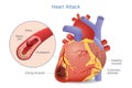 Illustration of Arterial thrombosis is a blood clot that develops to heart attack.