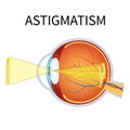 Illustration of astigmatism.