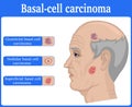 Illustration of Basal cell carcinoma