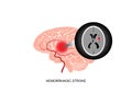 Illustration of cerebral hemorrhagic stroke and brain imaging