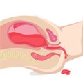 Illustration of the bleeding during pregnancy. Postapartum hemorrhage vector illustration Royalty Free Stock Photo