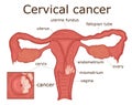 Illustration of cervical cancer Royalty Free Stock Photo