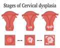 Illustration of Cervical dysplasia Royalty Free Stock Photo