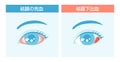 Illustration comparing subconjunctival hemorrhage and conjunctival congestion Royalty Free Stock Photo