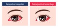 Illustration comparing subconjunctival hemorrhage and conjunctival congestion Royalty Free Stock Photo